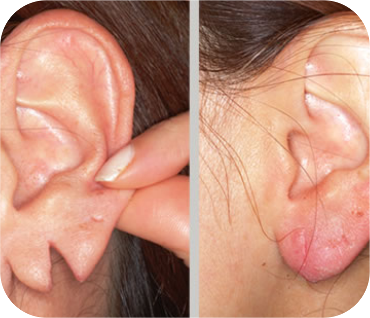 Earlobe Repair (Permanent)