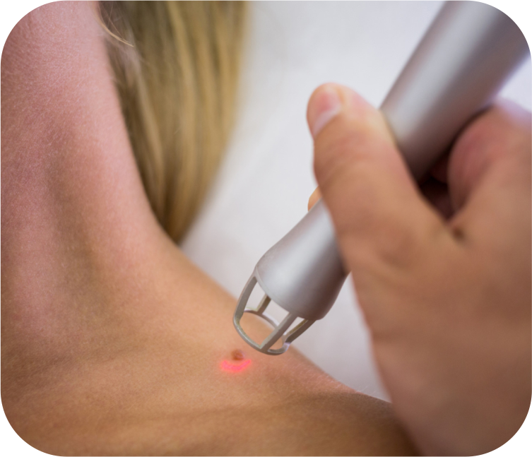 Skin Tag Removal