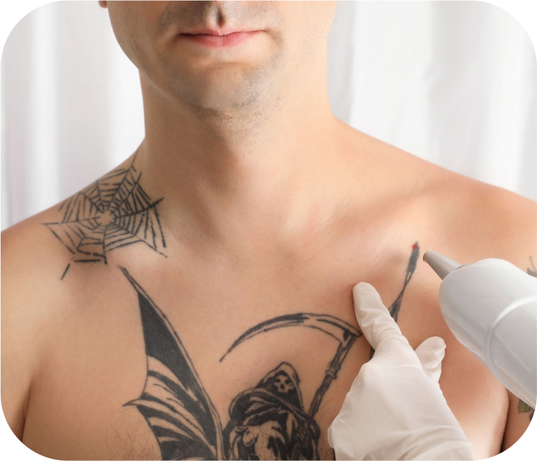Tattoo Removal