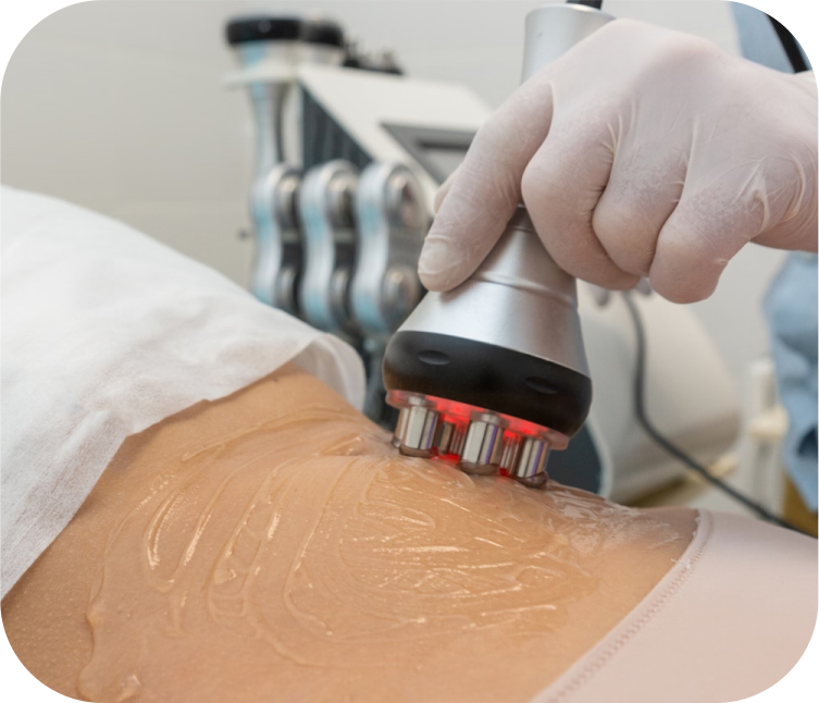 RF Skin Tightening