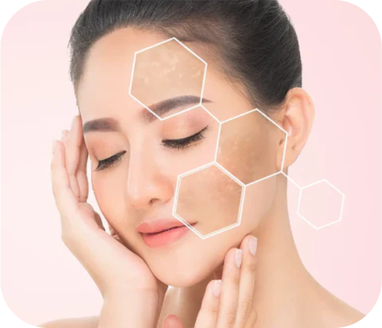 Melasma, Acne, Freckles Treatment