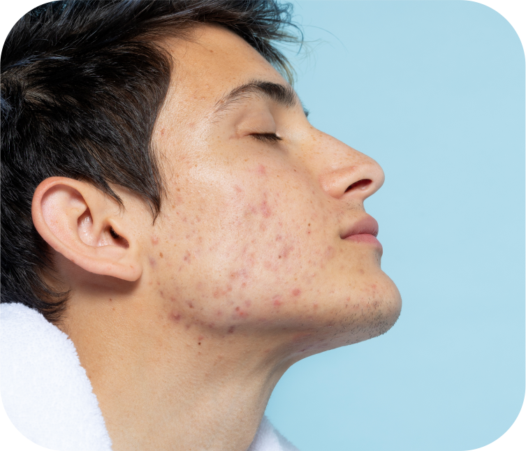 Melasma Acne Freckles Treatment Process