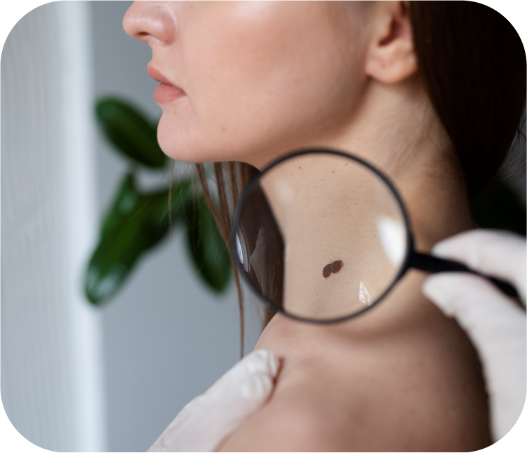 Mole Removal Treatment